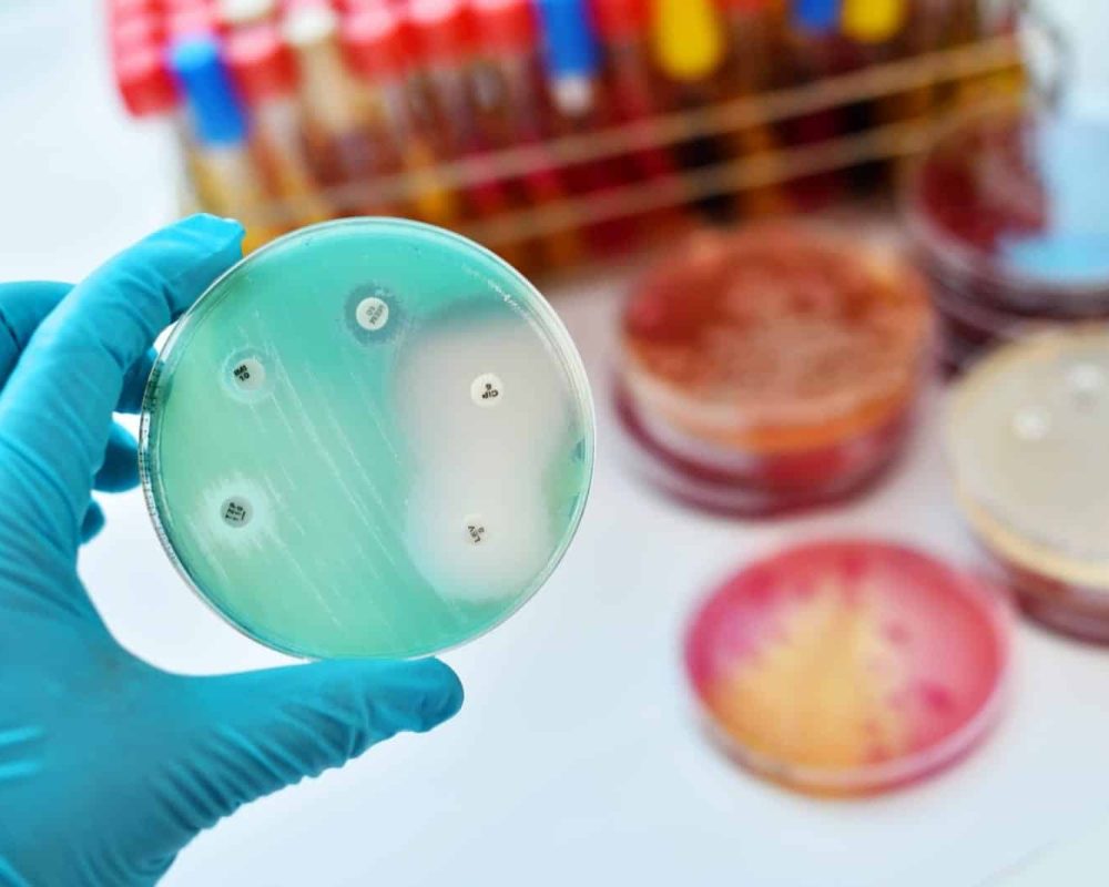 Ulcerative colitis and dysentery