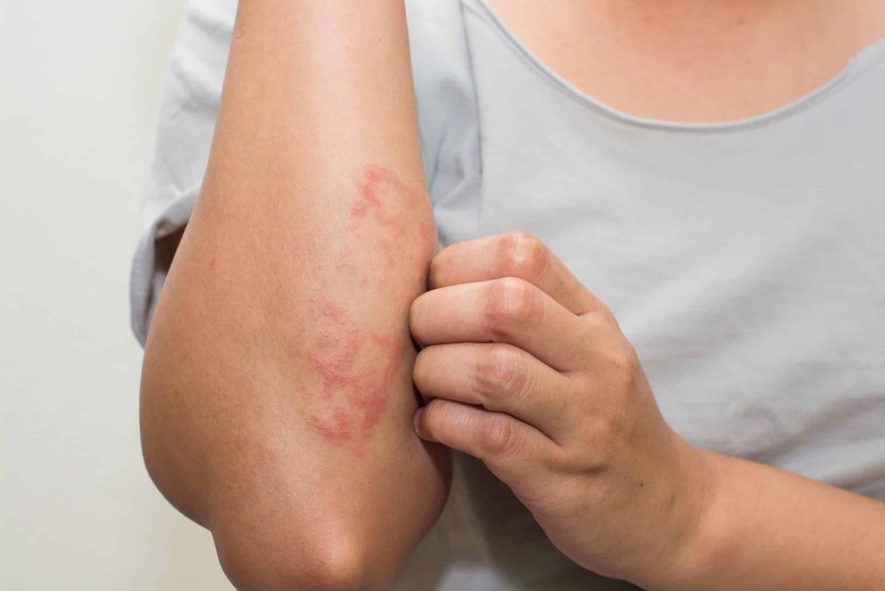 Unpicking a complex immunological skin problem