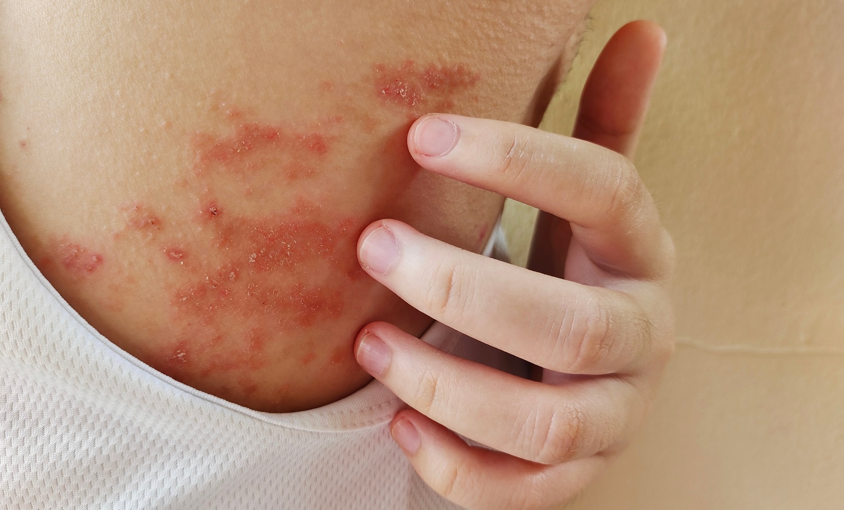Eczema Conditions Herbal Reality Eczema Conditions Herbal Reality