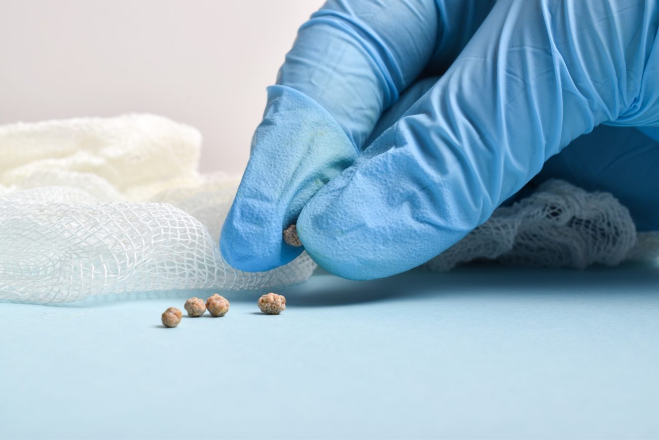Symptoms Of Gallstones
