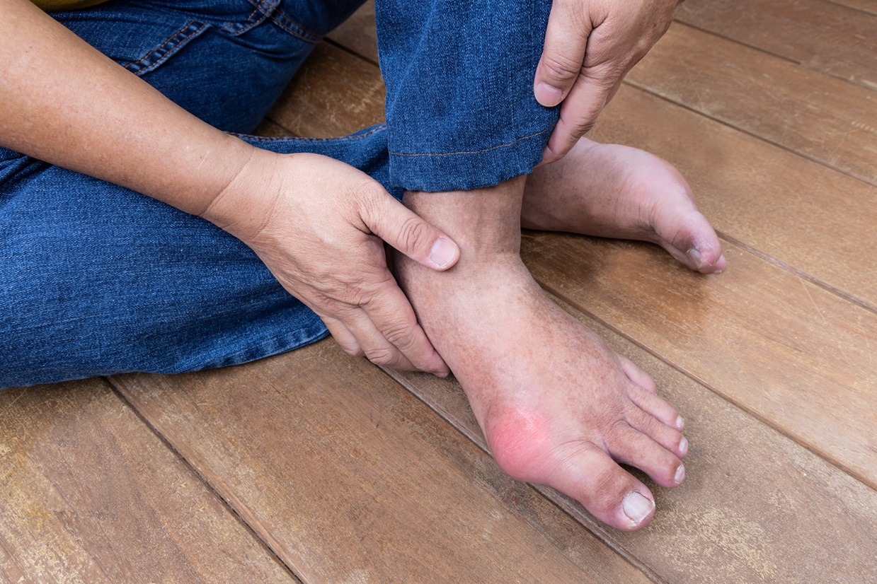 Symptoms Of Gout