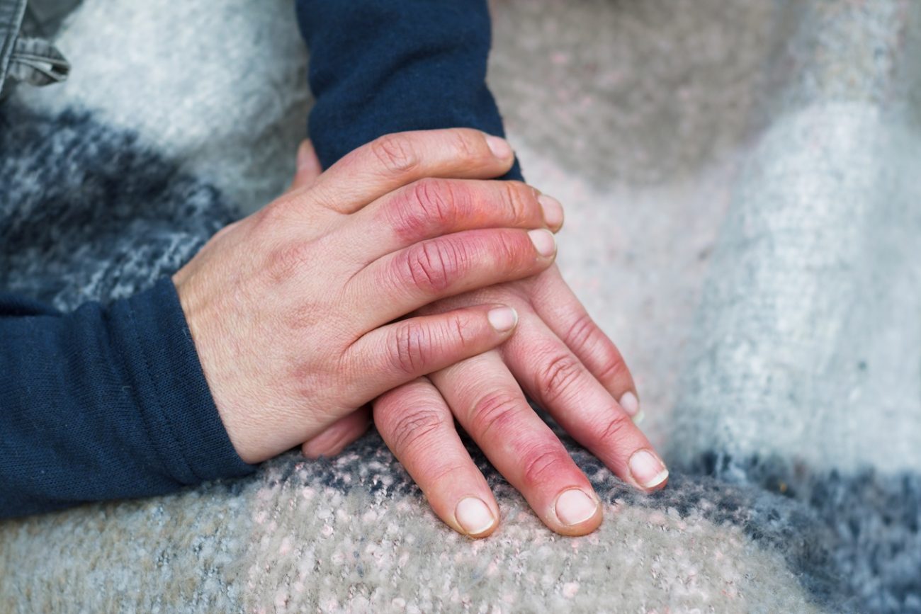 Poor Circulation Symptoms