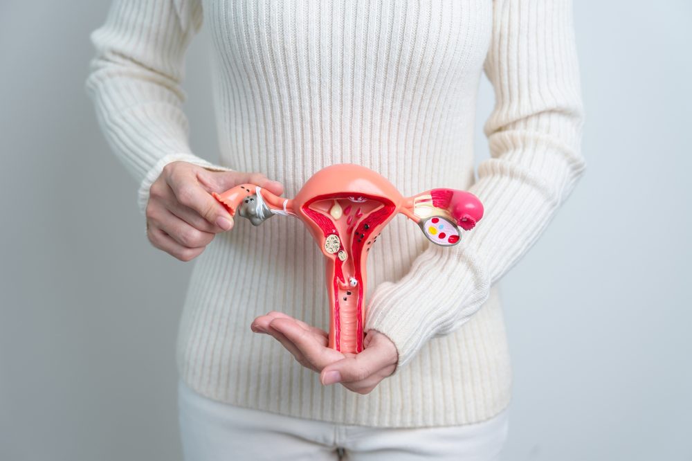 Uterine Fibroids