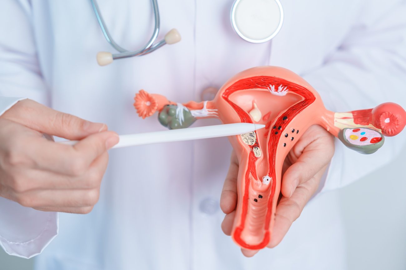 Uterine Fibroids Causes